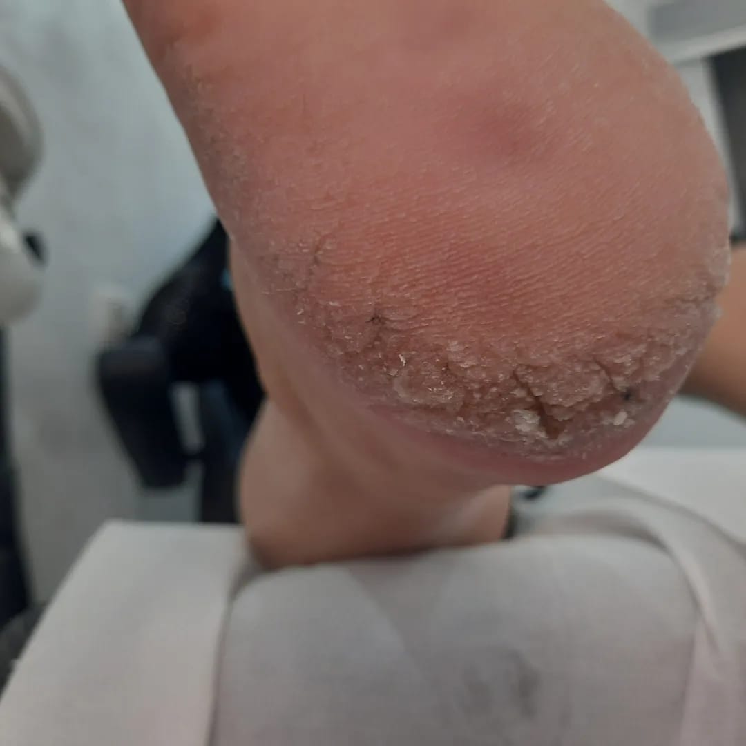 Tratarea keratozei și hiperkeratozei