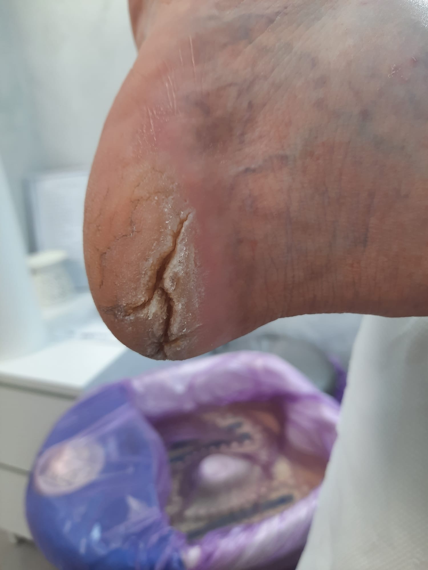 Tratarea keratozei și hiperkeratozei