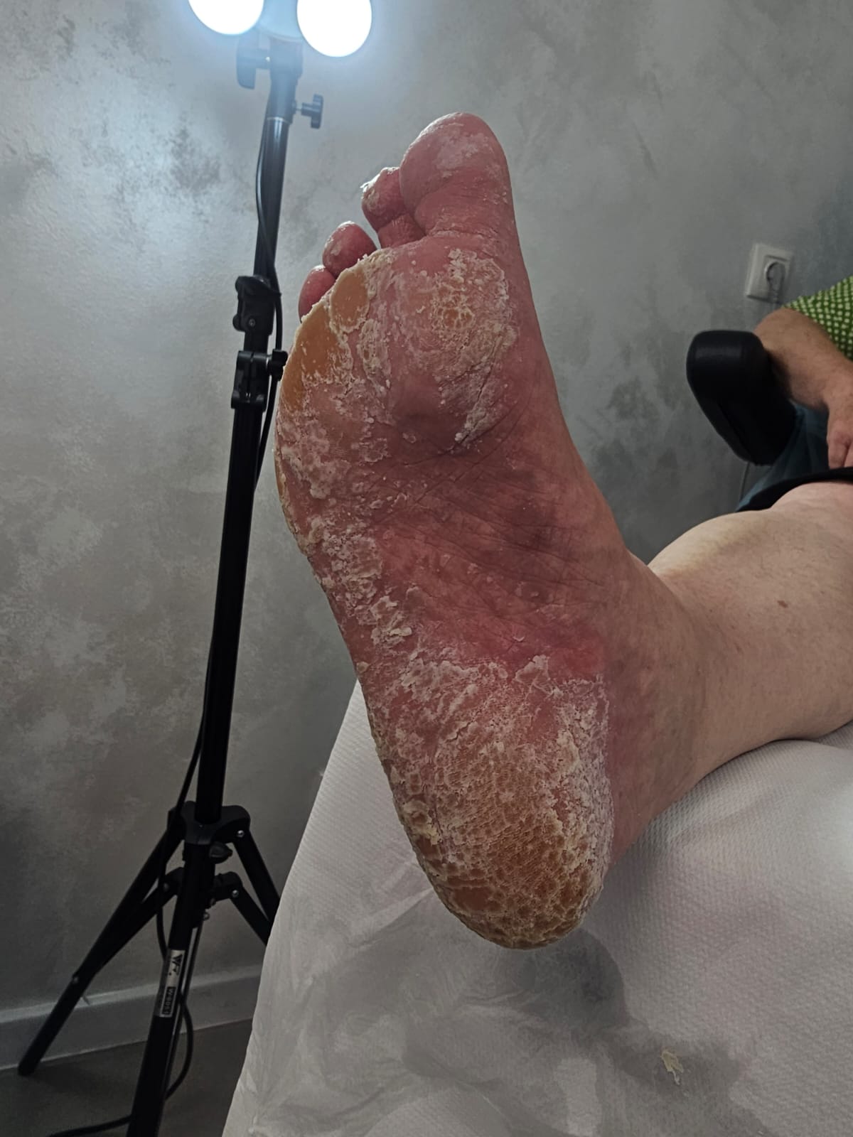 Tratarea keratozei și hiperkeratozei