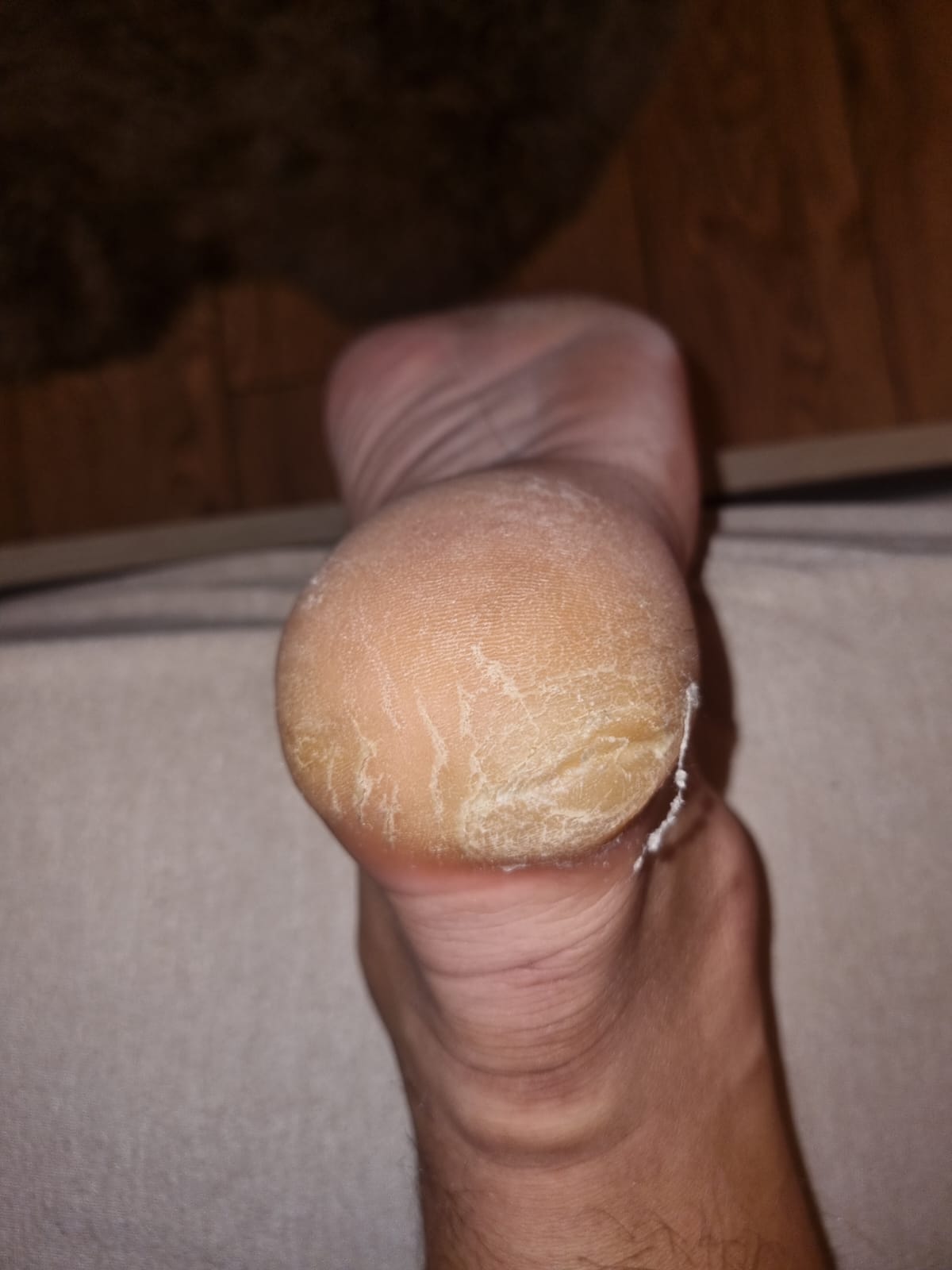 Tratarea keratozei și hiperkeratozei