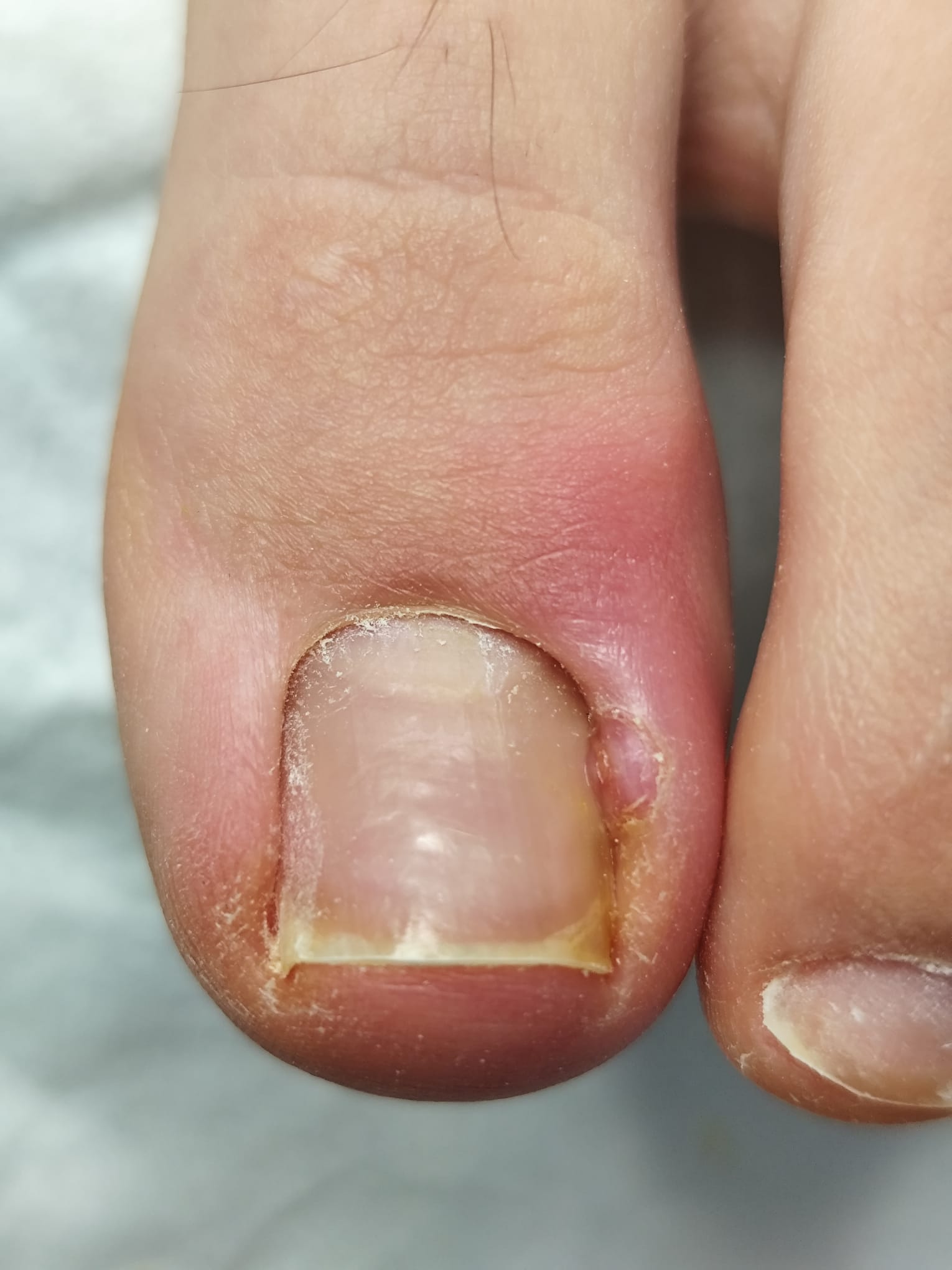 Tratare unghii incarnate