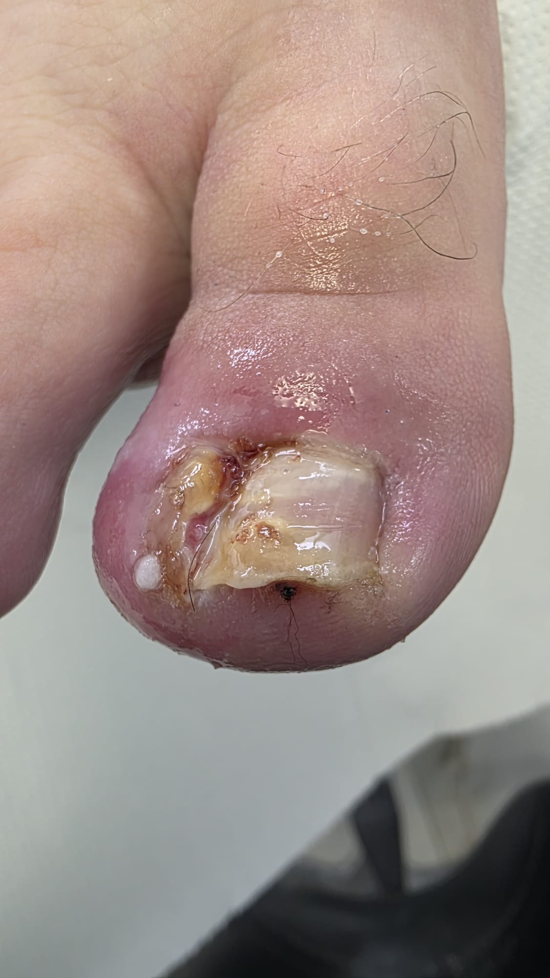 Tratarea non-invazivă a unghiilor incarnate