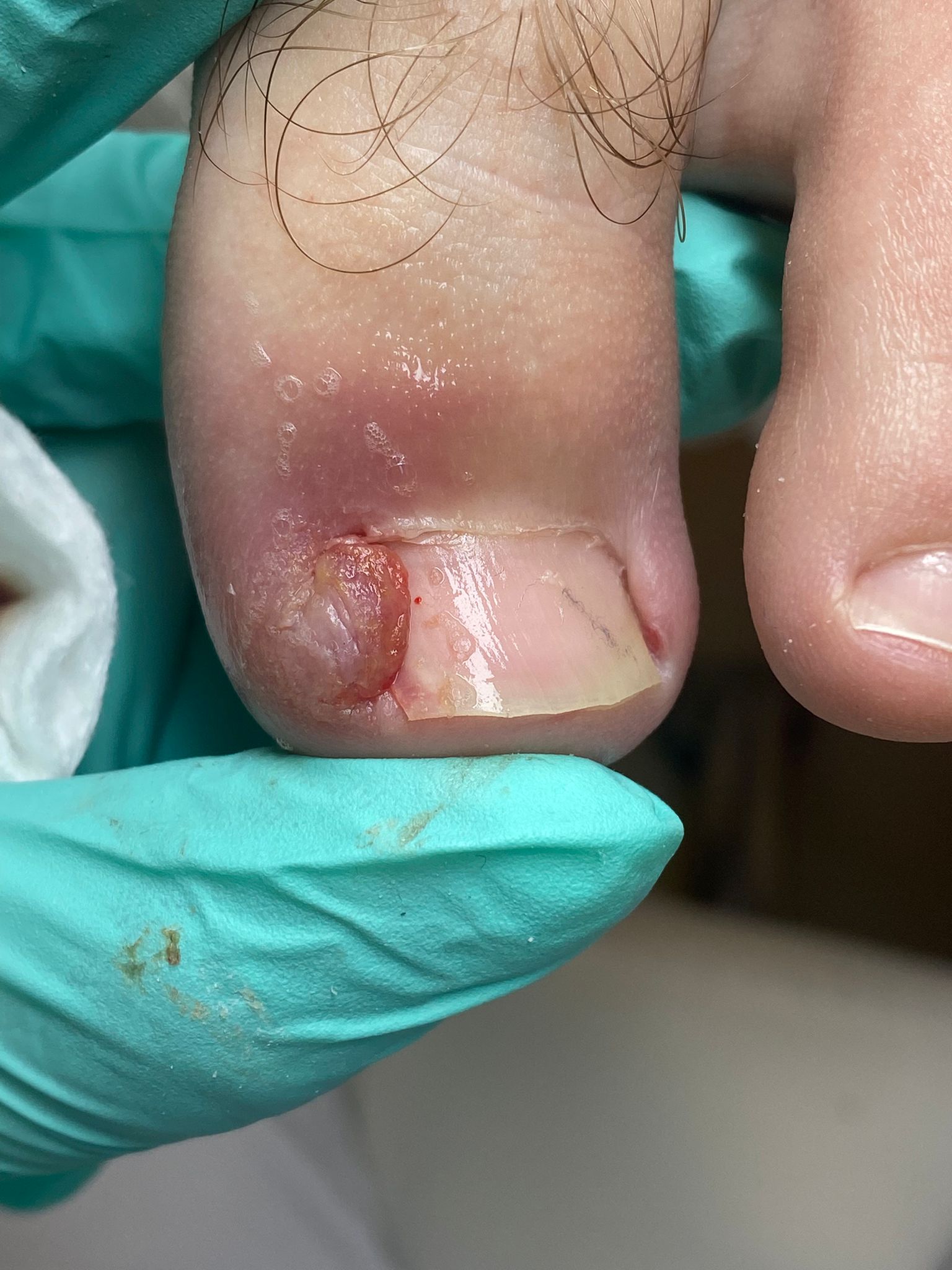 Tratare unghii incarnate