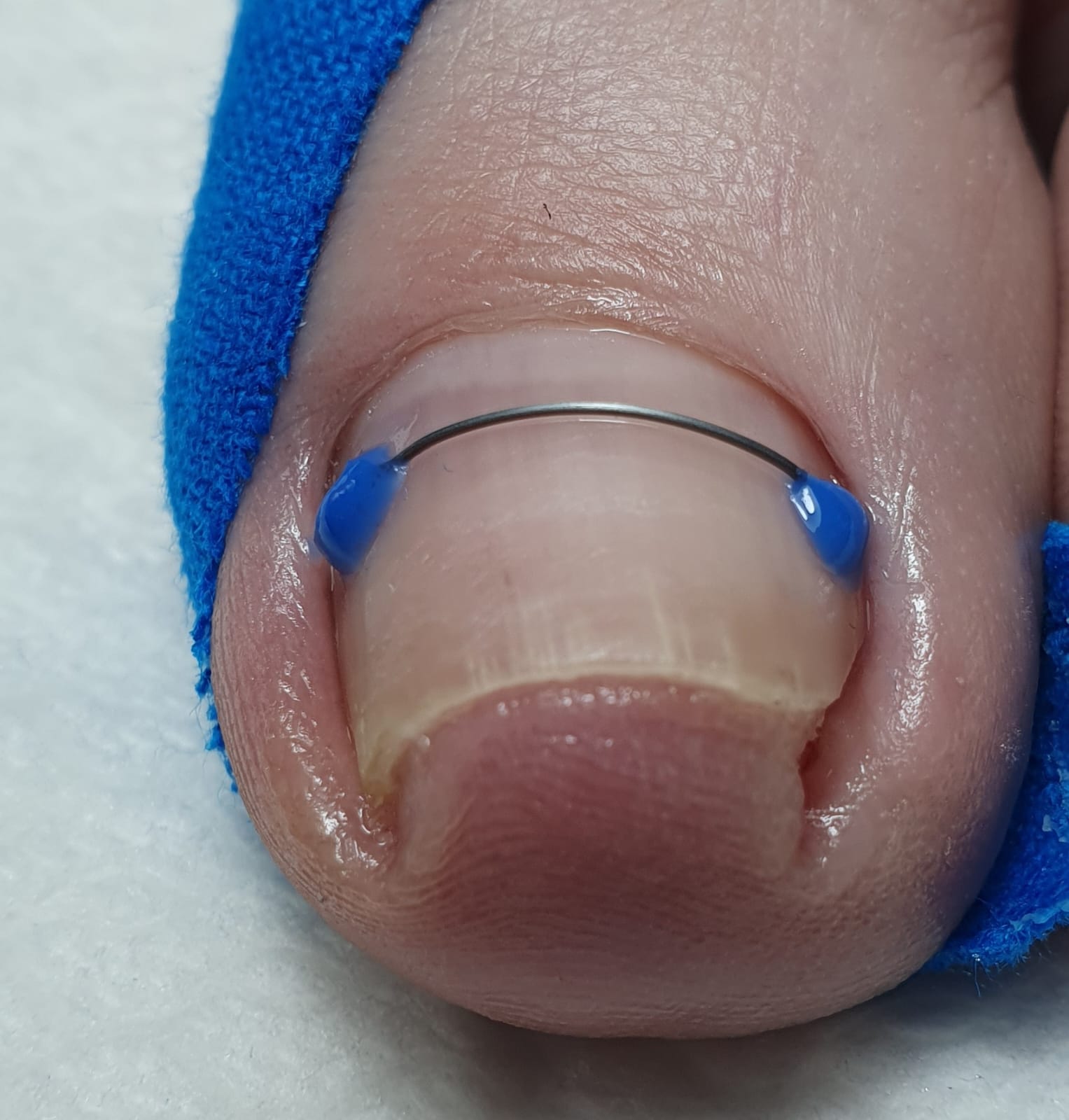 Tratarea non-invazivă a unghiilor incarnate