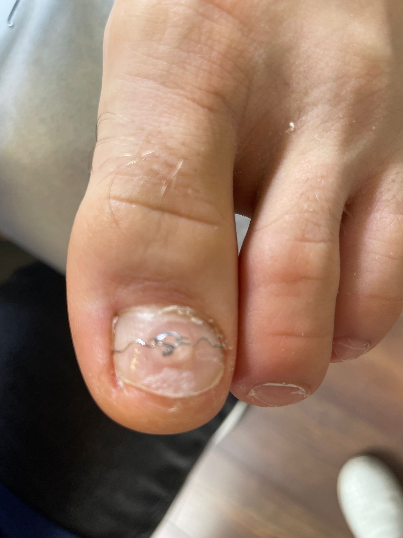 Tratarea non-invazivă a unghiilor incarnate