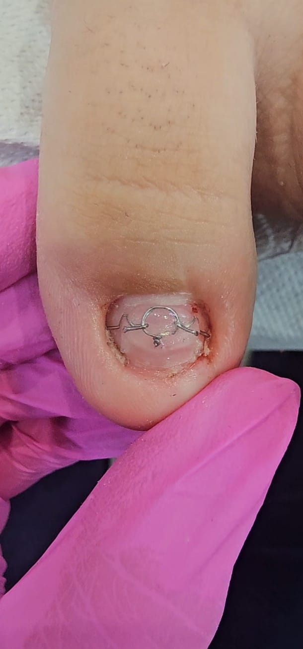 Tratarea non-invazivă a unghiilor incarnate