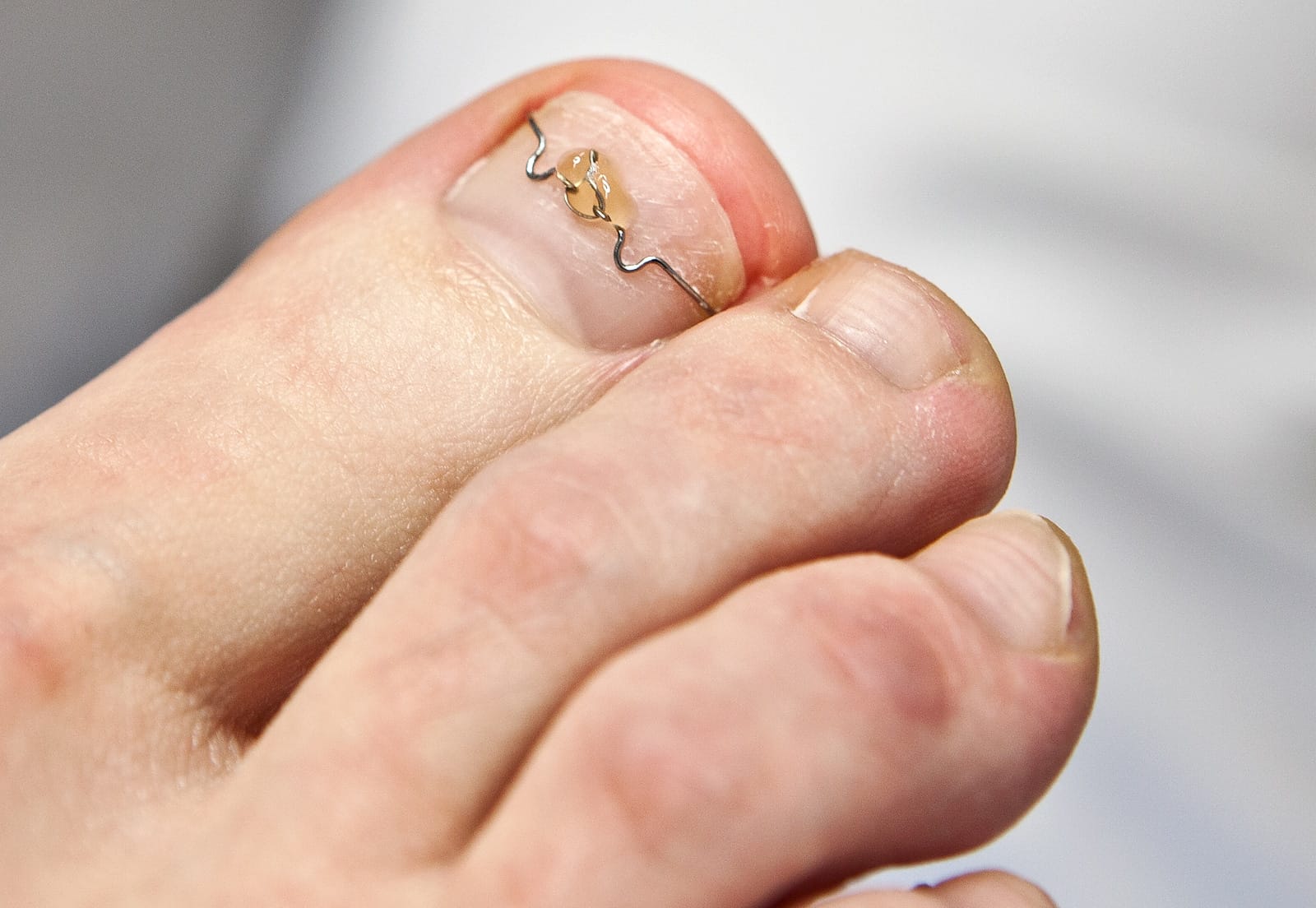 Tratarea non-invazivă a unghiilor incarnate