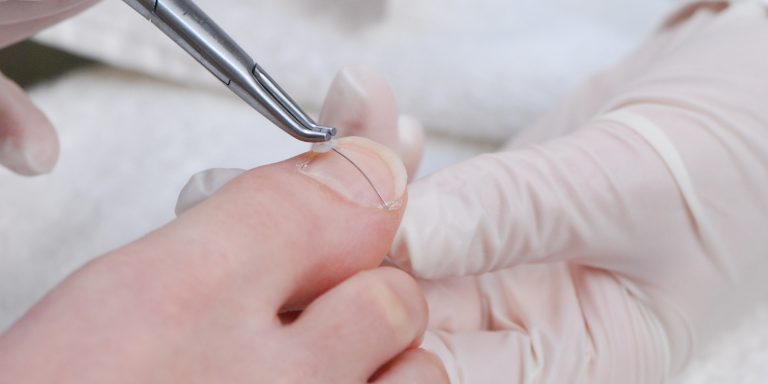 Tratarea non-invazivă a unghiilor incarnate