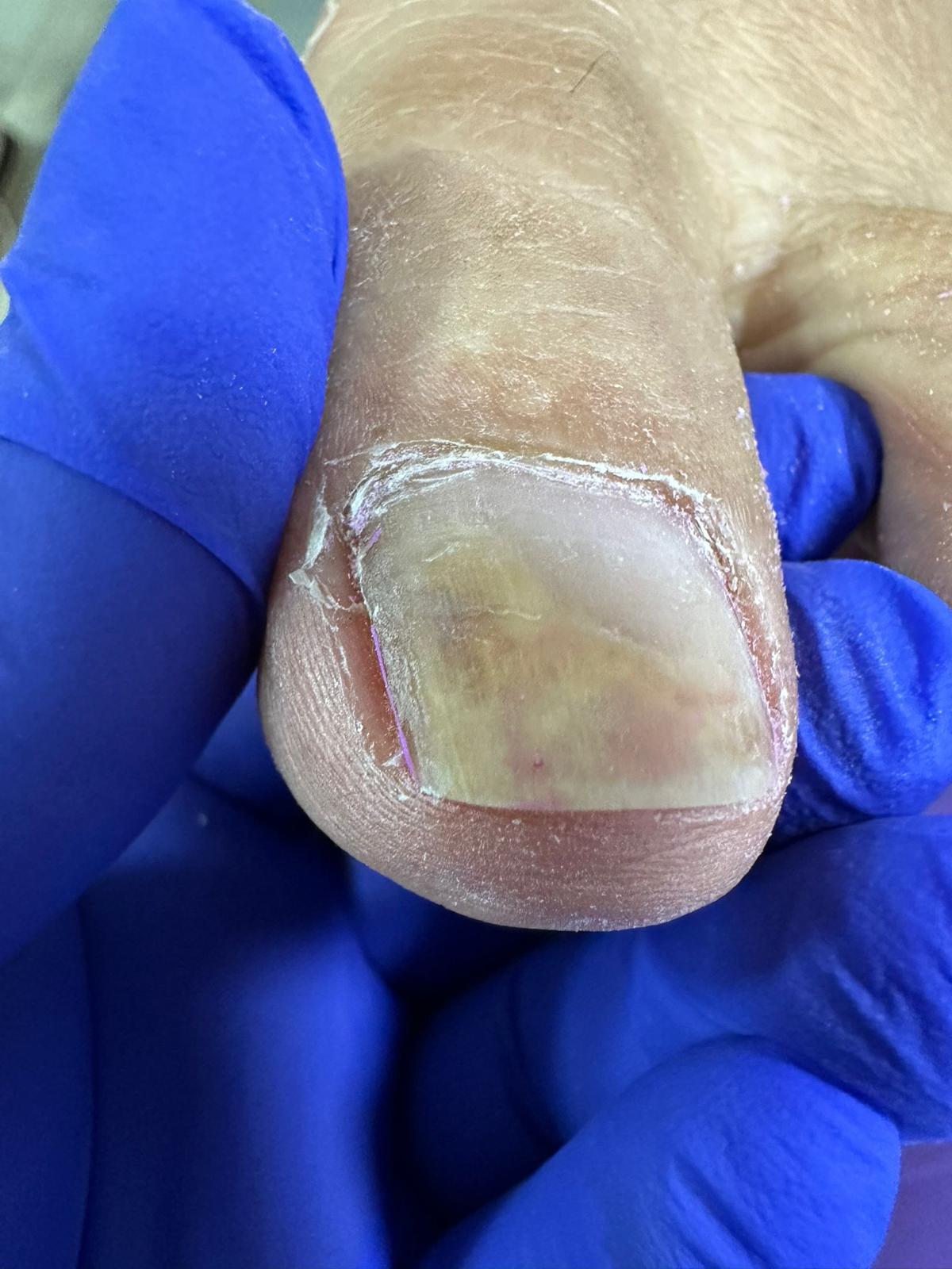 Tratarea unghiilor micotice