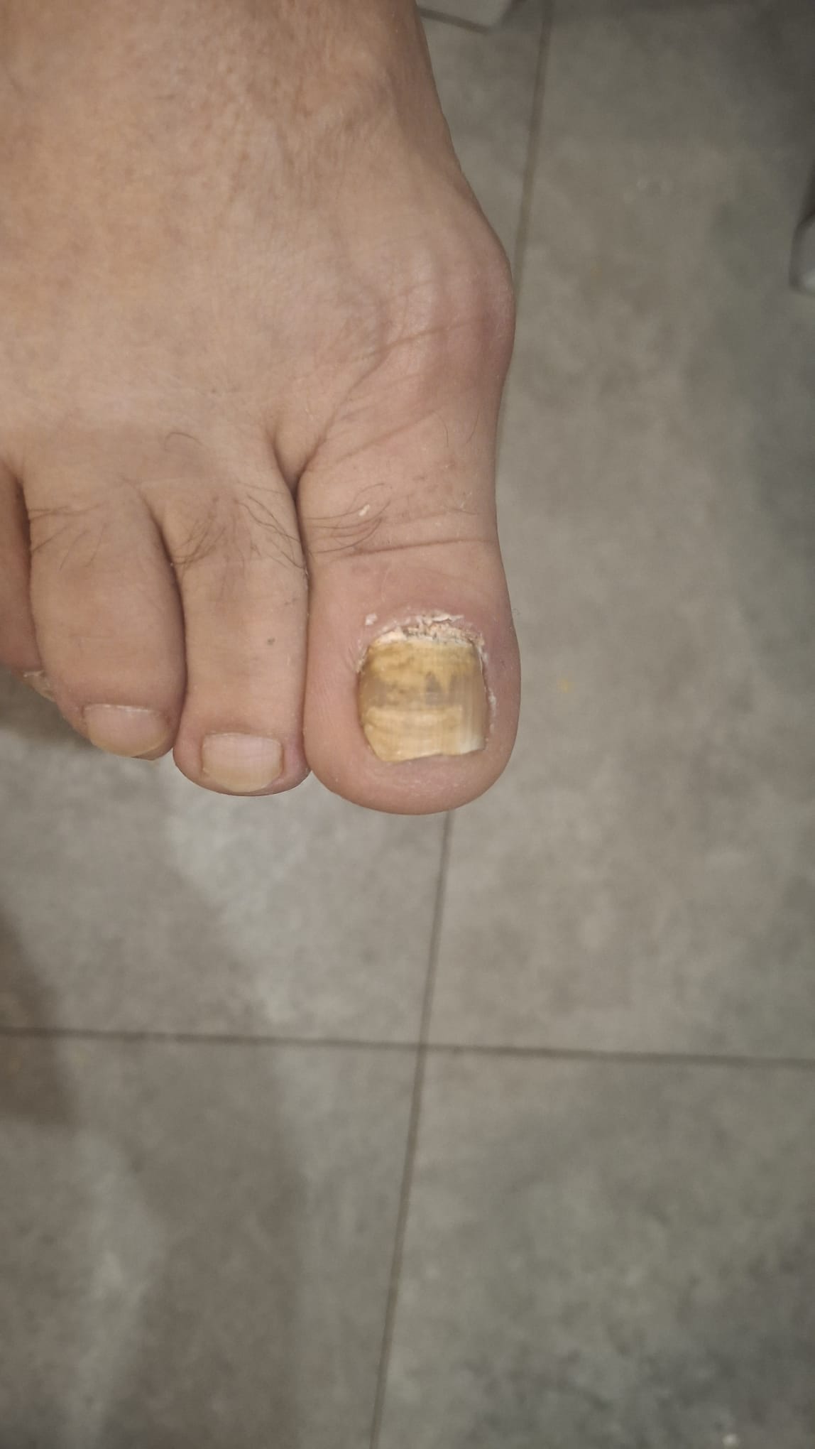 Tratarea unghiilor micotice