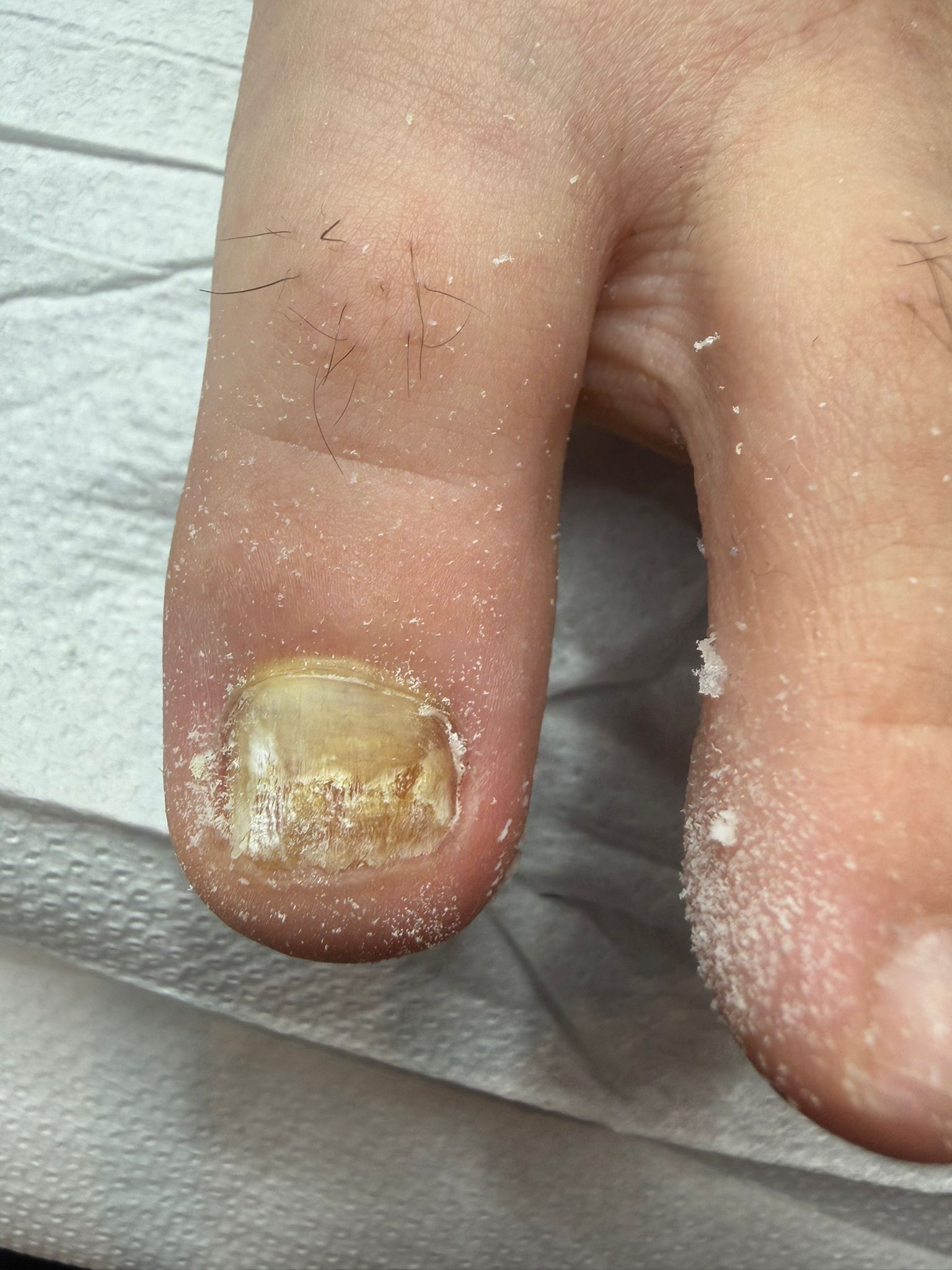 Tratarea unghiilor micotice