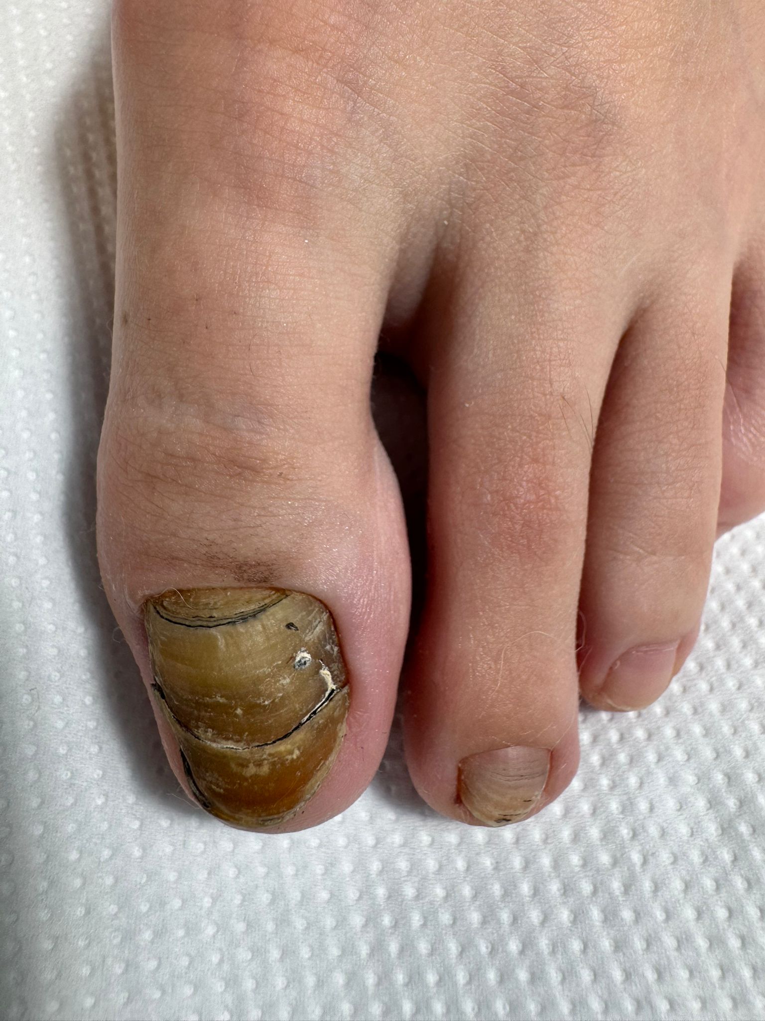 Tratare unghii micotice