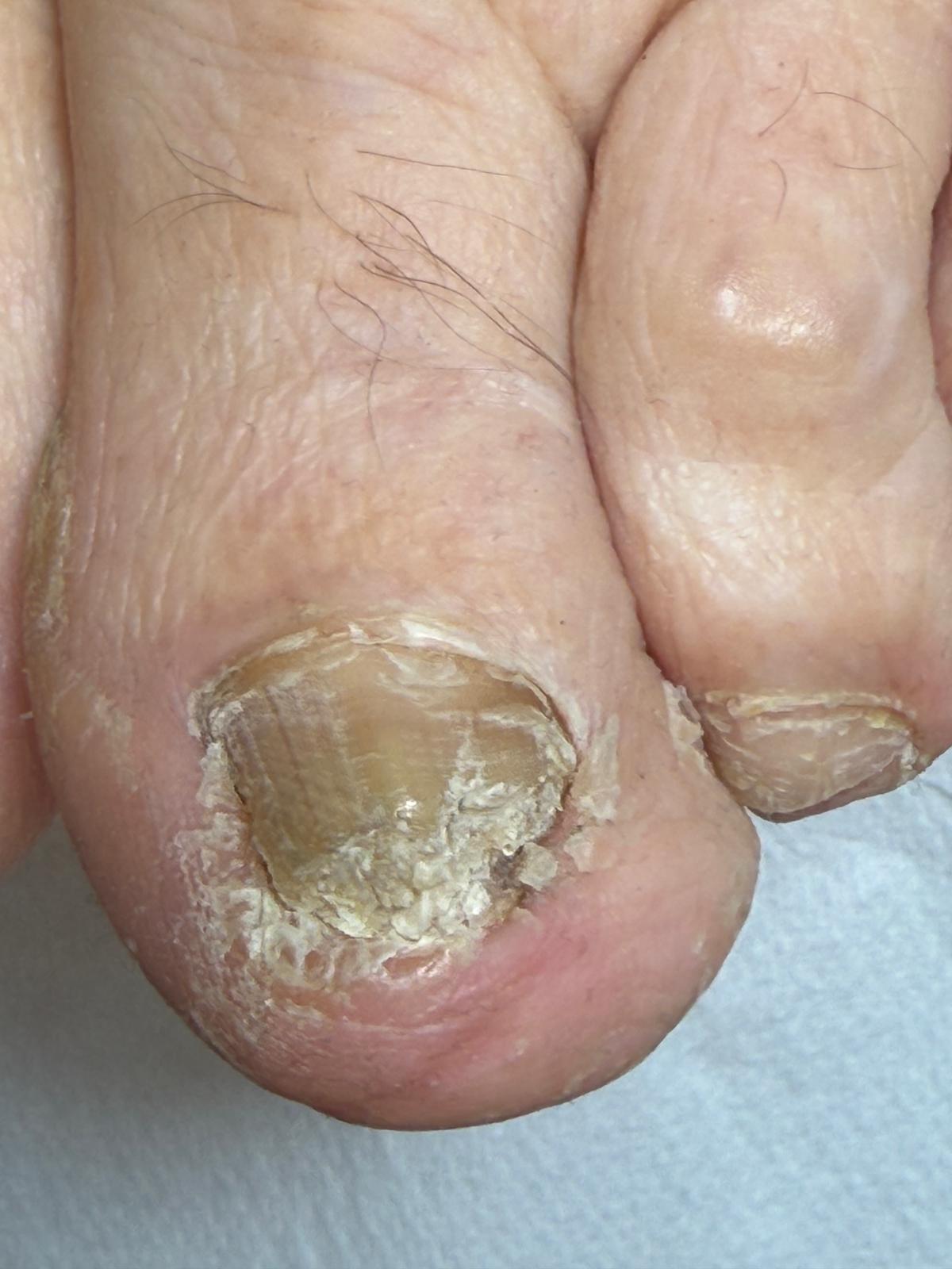 Tratarea unghiilor micotice